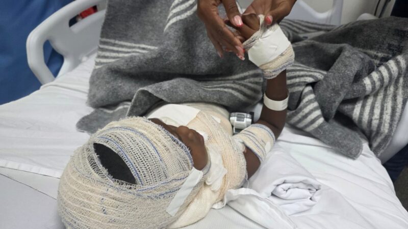 hospitais estaduais do RJ alertam para aumento de queimaduras durante festas juninas