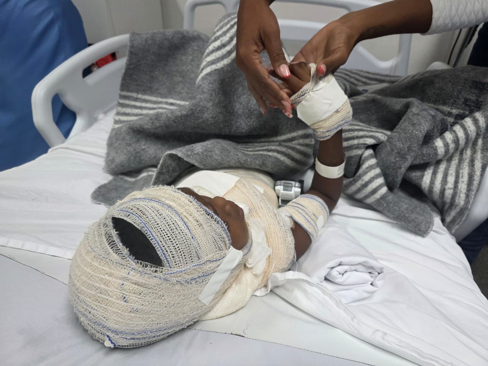 hospitais estaduais do RJ alertam para aumento de queimaduras durante festas juninas