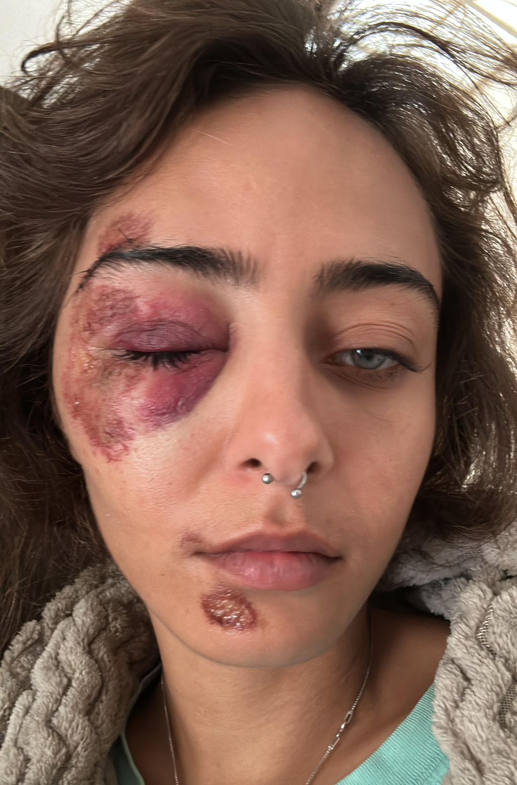 Estudante cai de bicicleta elétrica em buraco em Niterói e sofre ferimentos no rosto: “Fui arrastada no chão”