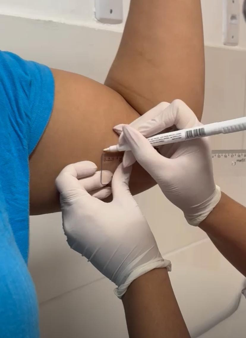 São Gonçalo faz mutirão para colocação de anticoncepcional subdérmico